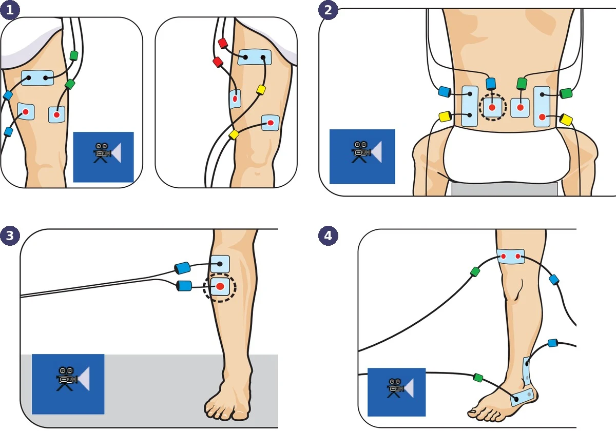 Chattanooga Physio elektroodide asetus: ACL, alaselg, hemipleegiline labajalg, turse