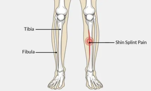 Sääreluu valu (shin splints)