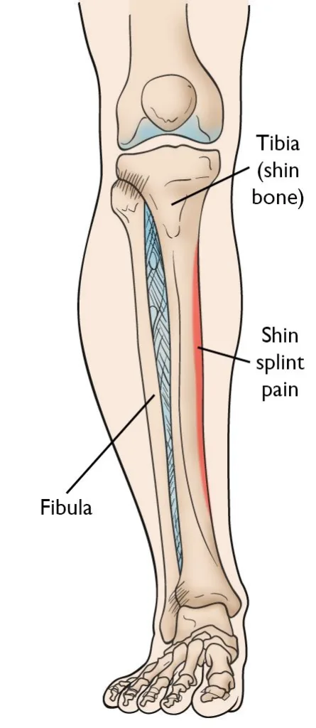Sääreluu valu (shin splints)