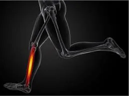 Sääreluu valu (shin splints)